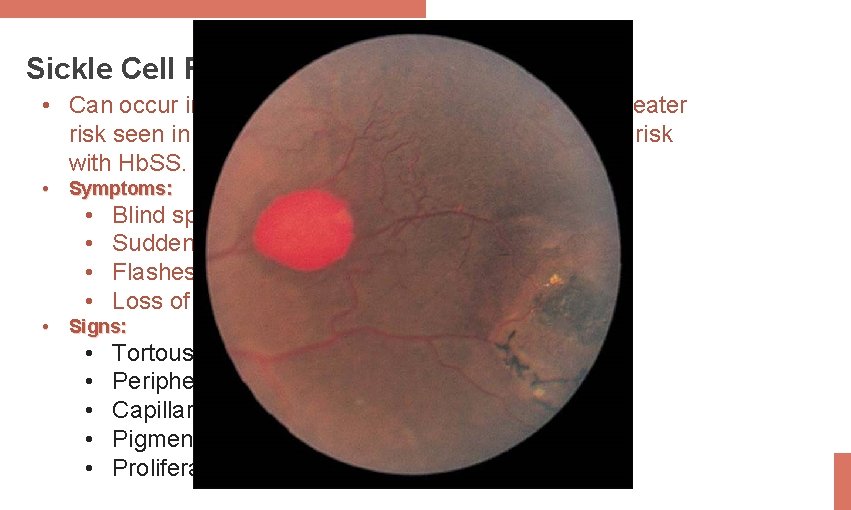 Sickle Cell Retinopathy • Can occur in any sickling hemoglobinopathies with greater risk seen