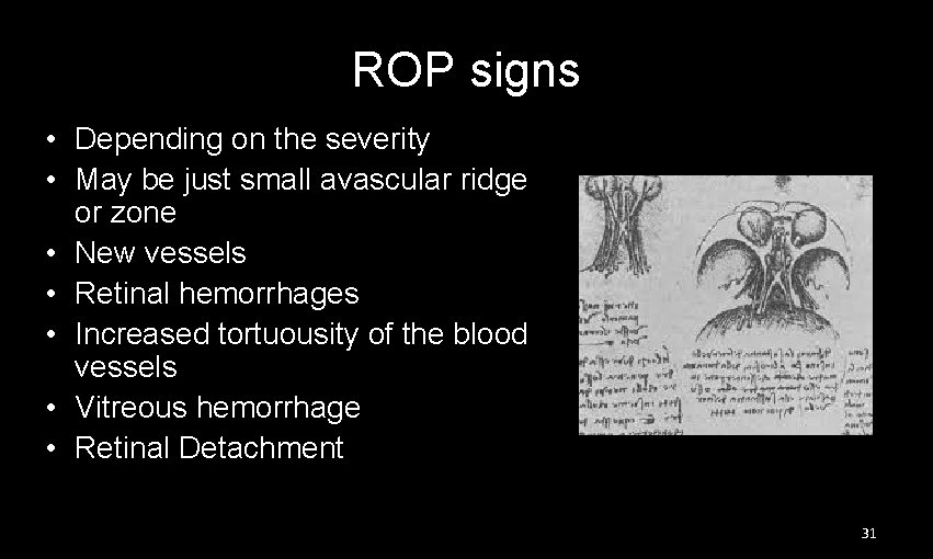 ROP signs • Depending on the severity • May be just small avascular ridge