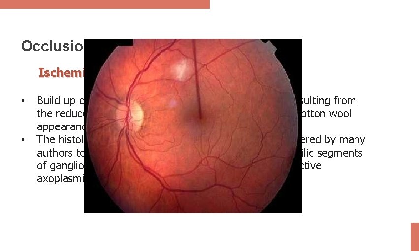 Occlusion Ischemia: • • Build up of the axonal debris in the nerve fibre