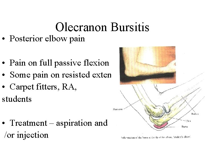 Olecranon Bursitis • Posterior elbow pain • Pain on full passive flexion • Some