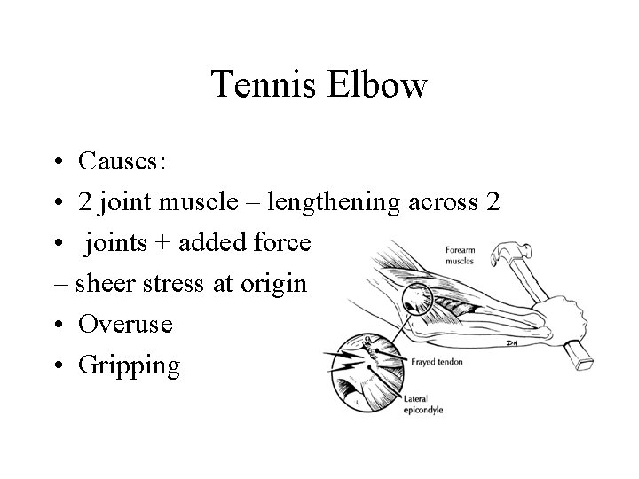 Tennis Elbow • Causes: • 2 joint muscle – lengthening across 2 • joints