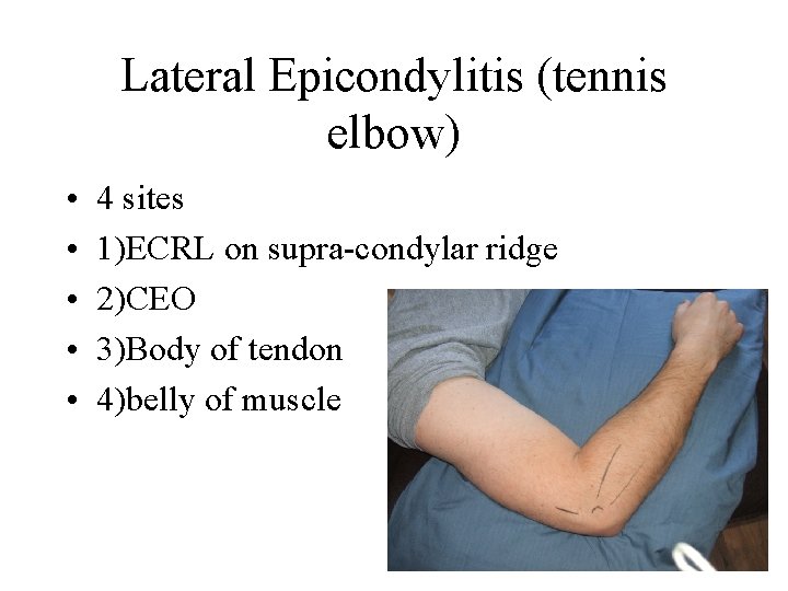 Lateral Epicondylitis (tennis elbow) • • • 4 sites 1)ECRL on supra-condylar ridge 2)CEO