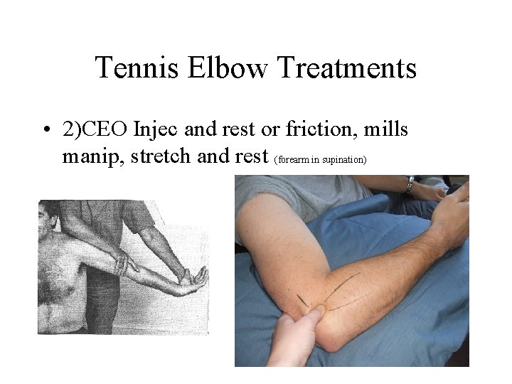 Tennis Elbow Treatments • 2)CEO Injec and rest or friction, mills manip, stretch and