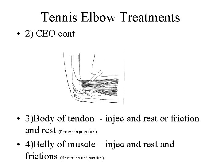 Tennis Elbow Treatments • 2) CEO cont • 3)Body of tendon - injec and