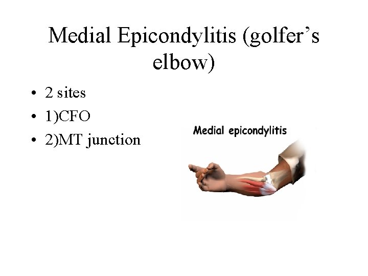 Medial Epicondylitis (golfer’s elbow) • 2 sites • 1)CFO • 2)MT junction 
