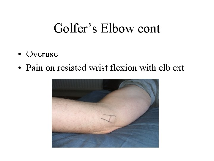 Golfer’s Elbow cont • Overuse • Pain on resisted wrist flexion with elb ext
