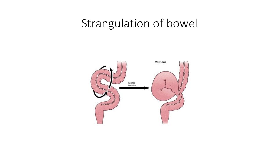 Strangulation of bowel 