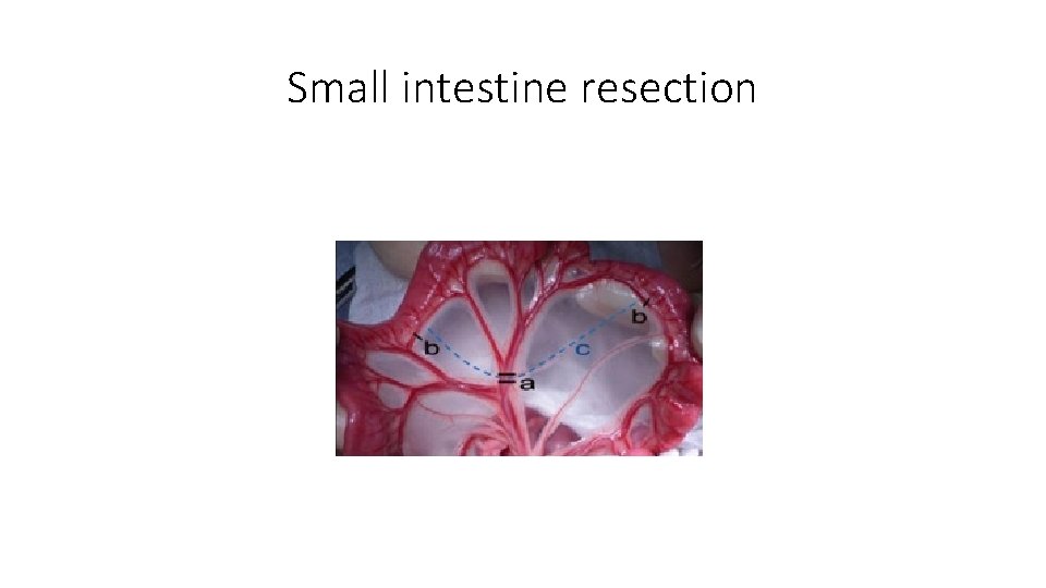 Small intestine resection 