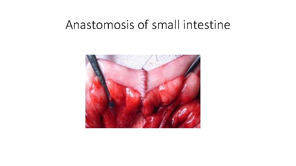 Anastomosis of small intestine 