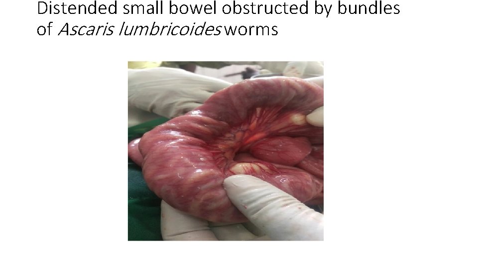 Distended small bowel obstructed by bundles of Ascaris lumbricoides worms 