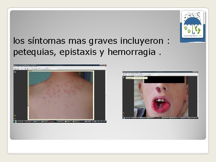 los síntomas graves incluyeron : petequias, epistaxis y hemorragia. 