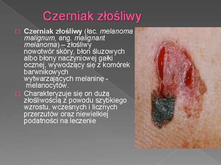 Czerniak złośliwy (łac. melanoma malignum, ang. malignant melanoma) – złośliwy nowotwór skóry, błon śluzowych