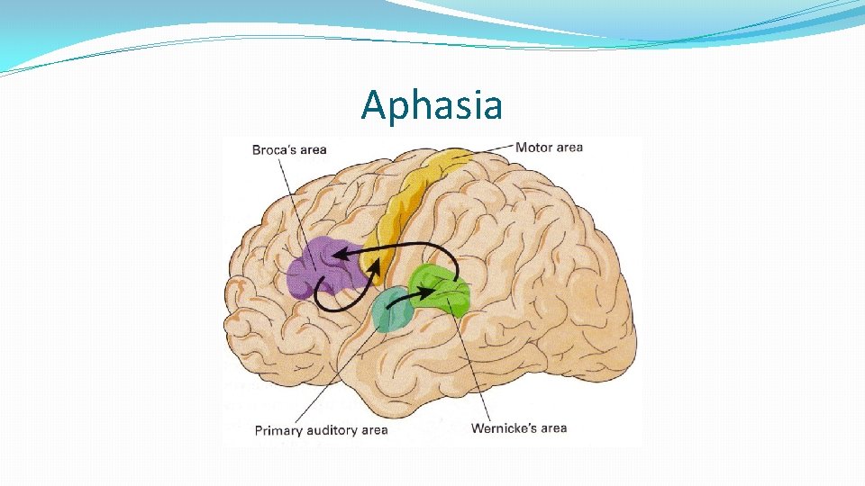 Aphasia 