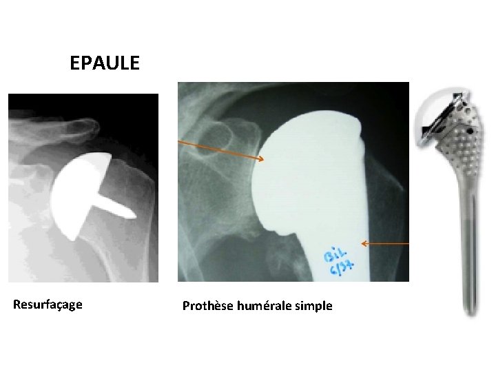 EPAULE Resurfaçage Prothèse humérale simple 