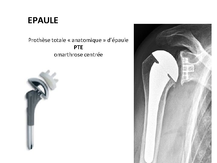 EPAULE Prothèse totale « anatomique » d’épaule PTE omarthrose centrée 