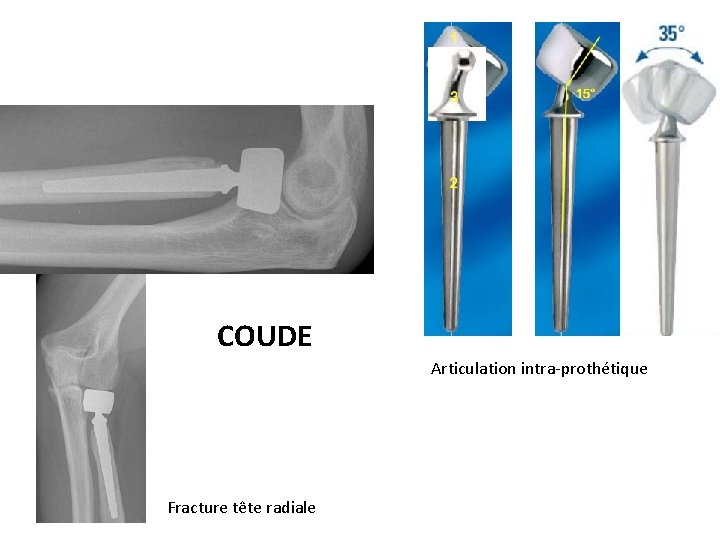 COUDE Articulation intra-prothétique Fracture tête radiale 