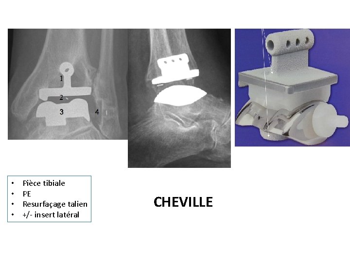  • • Pièce tibiale PE Resurfaçage talien +/- insert latéral CHEVILLE 