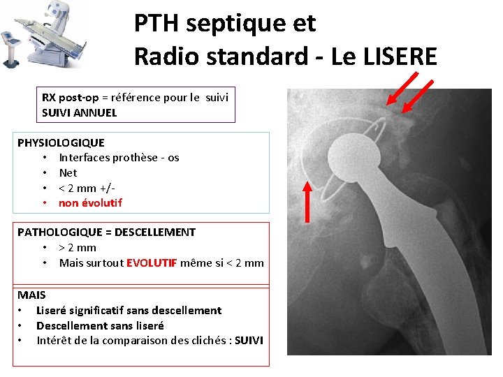 PTH septique et Radio standard - Le LISERE RX post-op = référence pour le