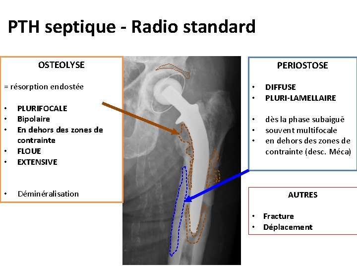 PTH septique - Radio standard OSTEOLYSE = résorption endostée • • PLURIFOCALE Bipolaire En