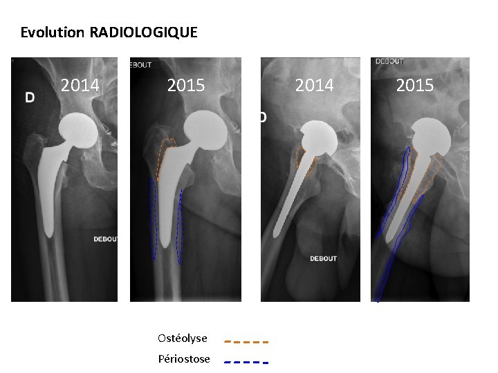 Evolution RADIOLOGIQUE 2014 2015 Ostéolyse Périostose 2015 2014 2015 