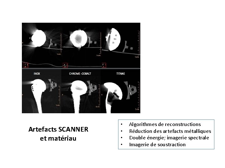 Artefacts SCANNER et matériau • • Algorithmes de reconstructions Réduction des artefacts métalliques Double