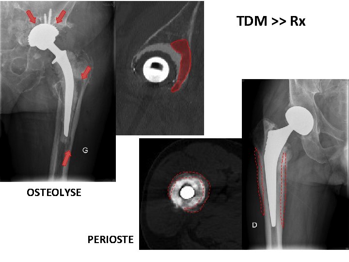 TDM >> Rx OSTEOLYSE PERIOSTE 