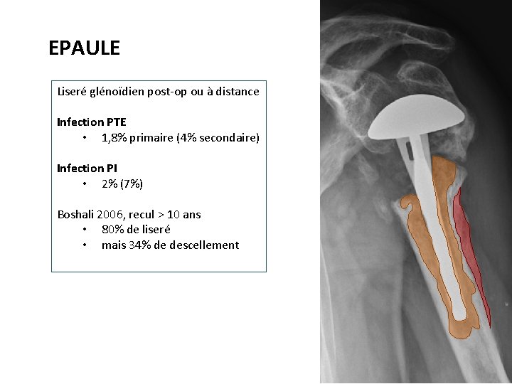 EPAULE Liseré glénoïdien post-op ou à distance Infection PTE • 1, 8% primaire (4%