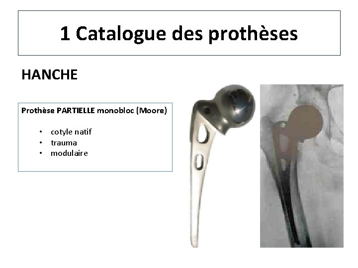 1 Catalogue des prothèses HANCHE Prothèse PARTIELLE monobloc (Moore) • cotyle natif • trauma