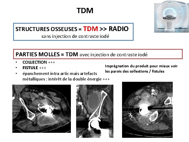 TDM STRUCTURES OSSEUSES = TDM >> RADIO sans injection de contraste iodé PARTIES MOLLES