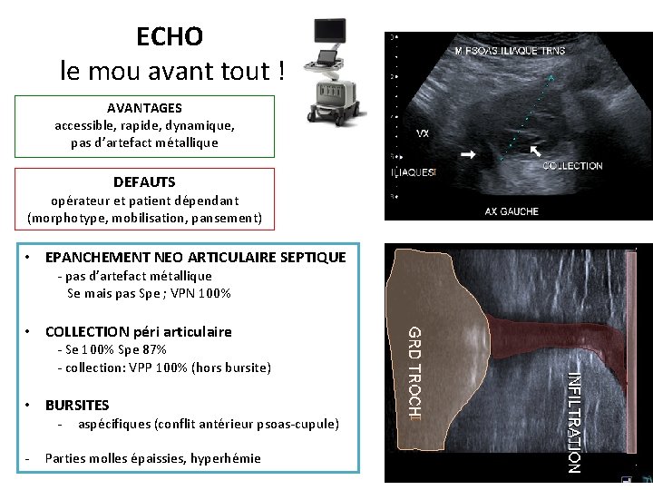 ECHO le mou avant tout ! AVANTAGES accessible, rapide, dynamique, pas d’artefact métallique DEFAUTS