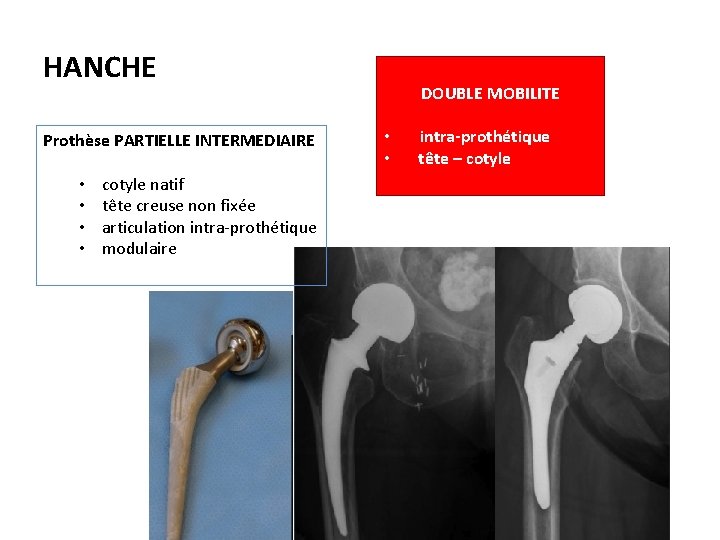 HANCHE Prothèse PARTIELLE INTERMEDIAIRE • • cotyle natif tête creuse non fixée articulation intra-prothétique