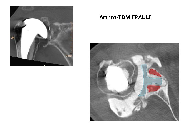 Arthro-TDM EPAULE 