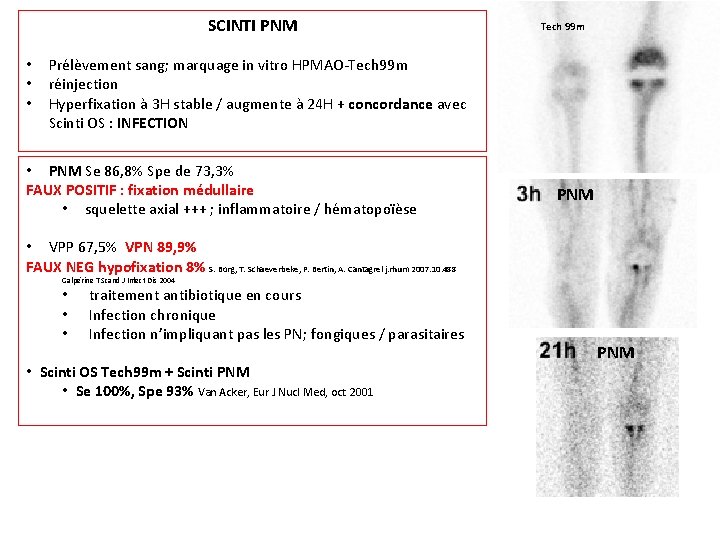 SCINTI PNM • • • Tech 99 m Prélèvement sang; marquage in vitro HPMAO-Tech