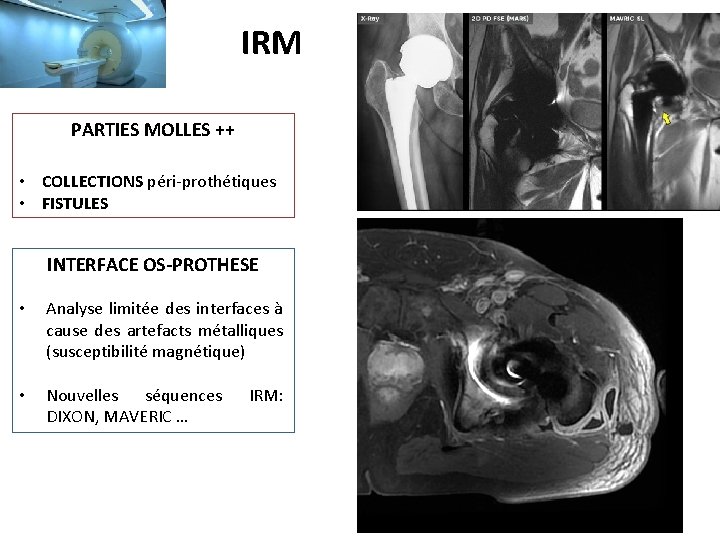 IRM PARTIES MOLLES ++ • COLLECTIONS péri-prothétiques • FISTULES INTERFACE OS-PROTHESE • Analyse limitée