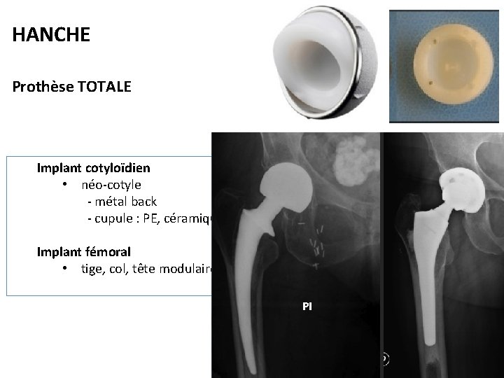 HANCHE Prothèse TOTALE Implant cotyloïdien • néo-cotyle - métal back - cupule : PE,
