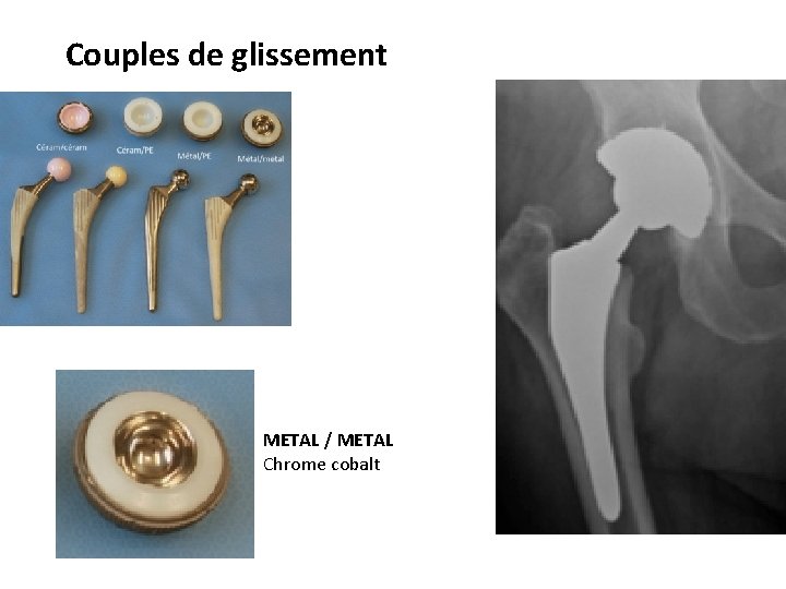 Couples de glissement METAL / METAL Chrome cobalt 