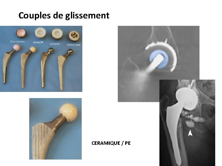 Couples de glissement CERAMIQUE / PE 