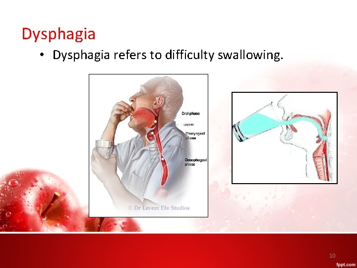 Dysphagia • Dysphagia refers to difficulty swallowing. 10 