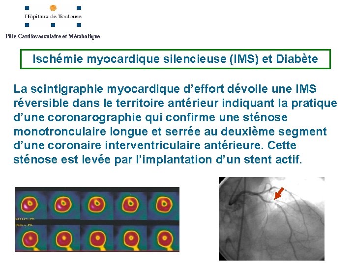 Pôle Cardiovasculaire et Métabolique Ischémie myocardique silencieuse (IMS) et Diabète La scintigraphie myocardique d’effort