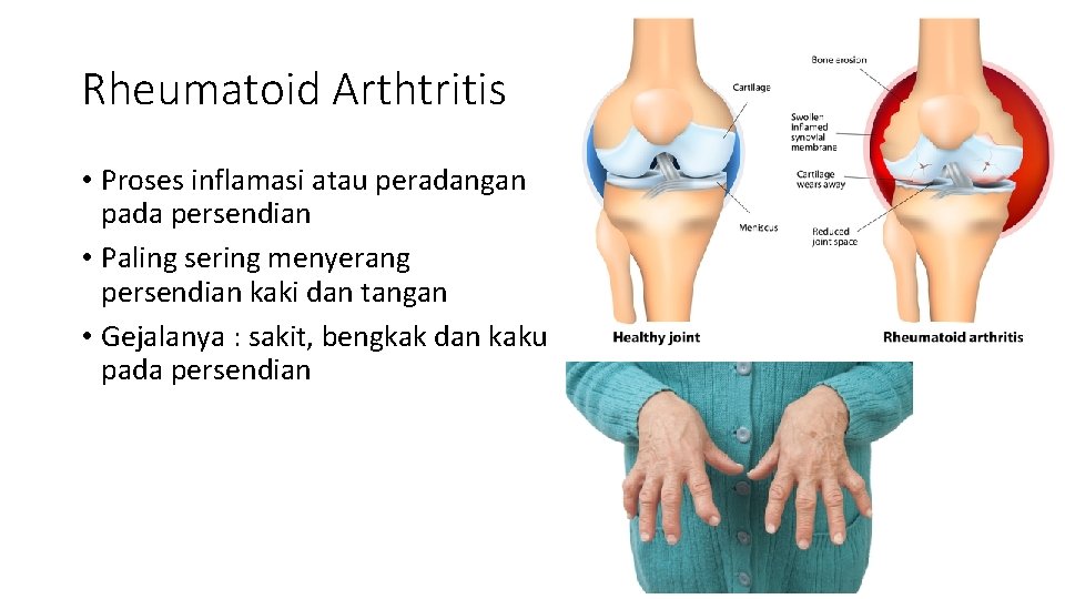 Rheumatoid Arthtritis • Proses inflamasi atau peradangan pada persendian • Paling sering menyerang persendian