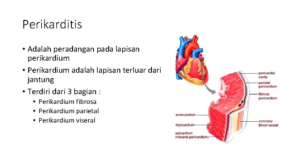 Perikarditis • Adalah peradangan pada lapisan perikardium • Perikardium adalah lapisan terluar dari jantung