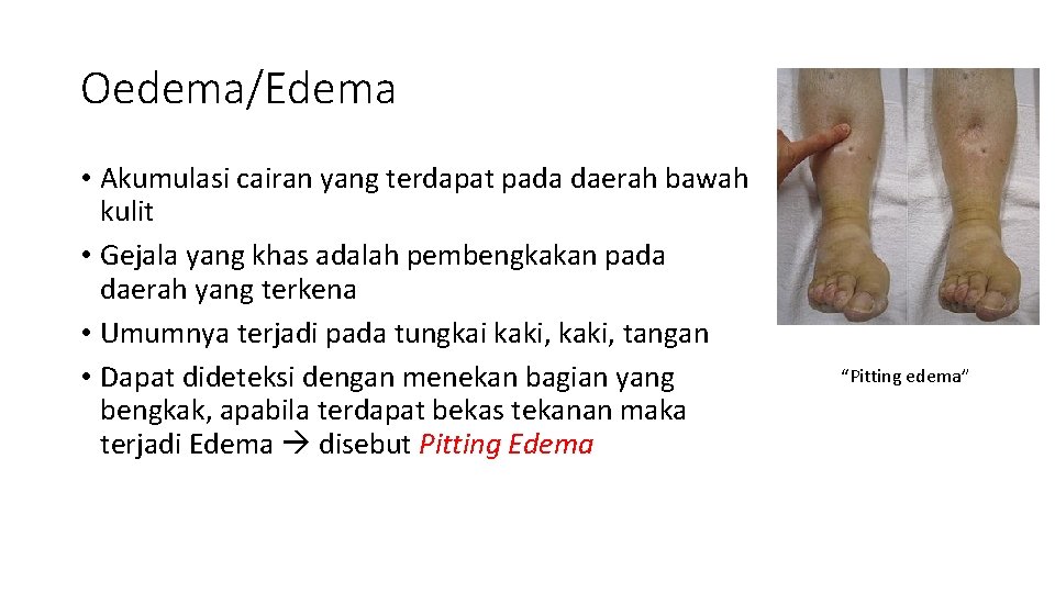 Oedema/Edema • Akumulasi cairan yang terdapat pada daerah bawah kulit • Gejala yang khas