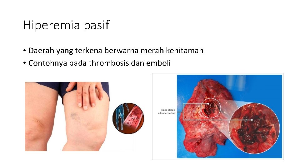 Hiperemia pasif • Daerah yang terkena berwarna merah kehitaman • Contohnya pada thrombosis dan