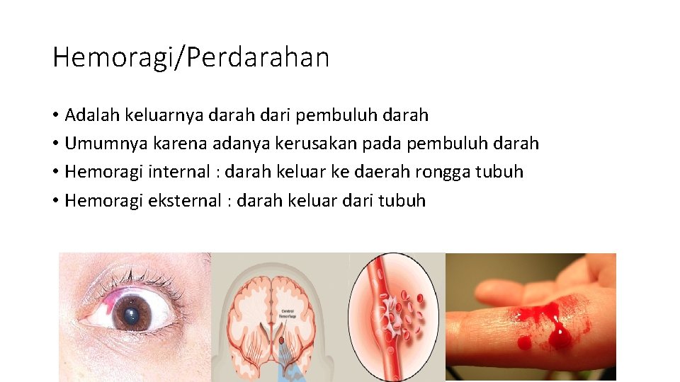 Hemoragi/Perdarahan • Adalah keluarnya darah dari pembuluh darah • Umumnya karena adanya kerusakan pada