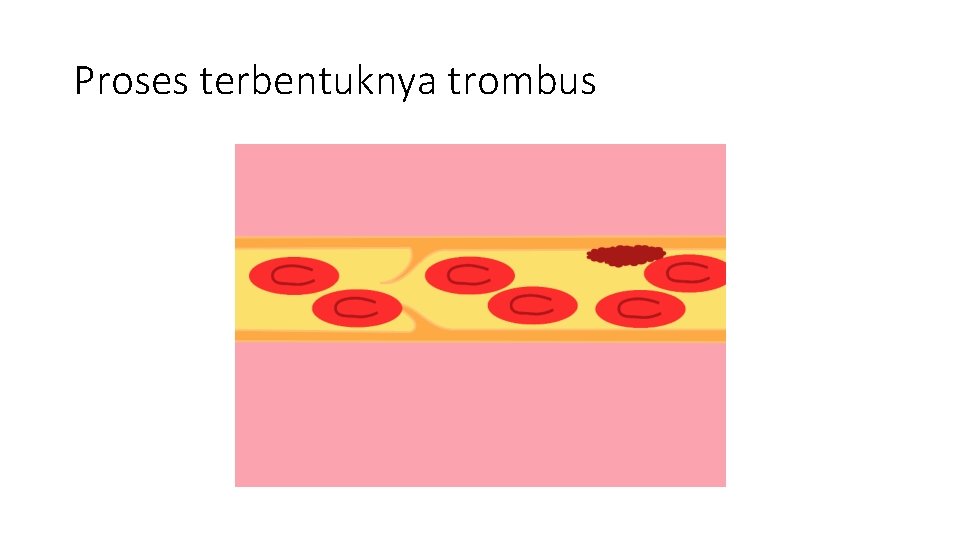 Proses terbentuknya trombus 