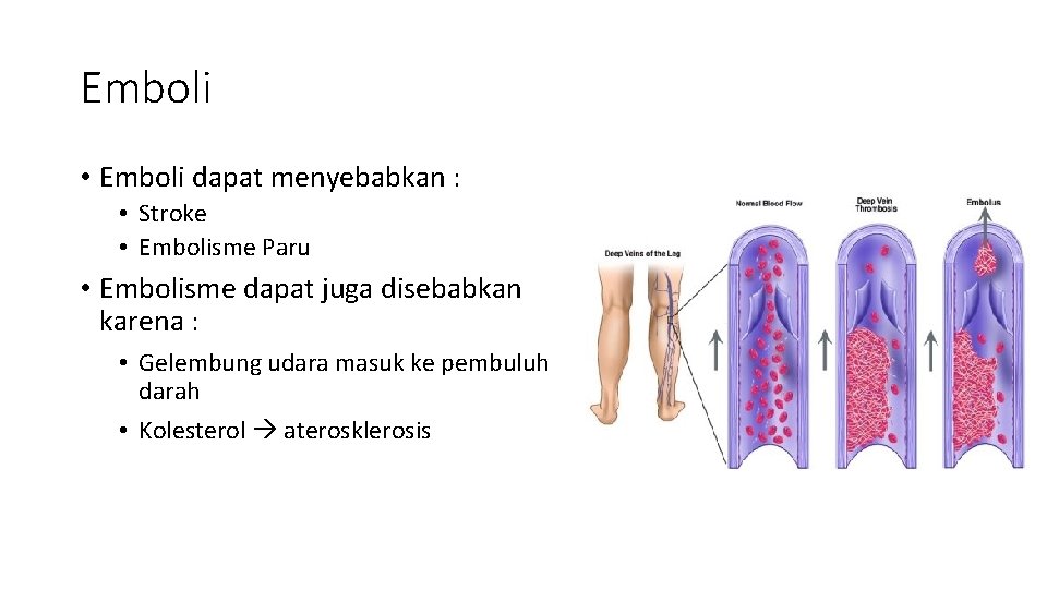 Emboli • Emboli dapat menyebabkan : • Stroke • Embolisme Paru • Embolisme dapat