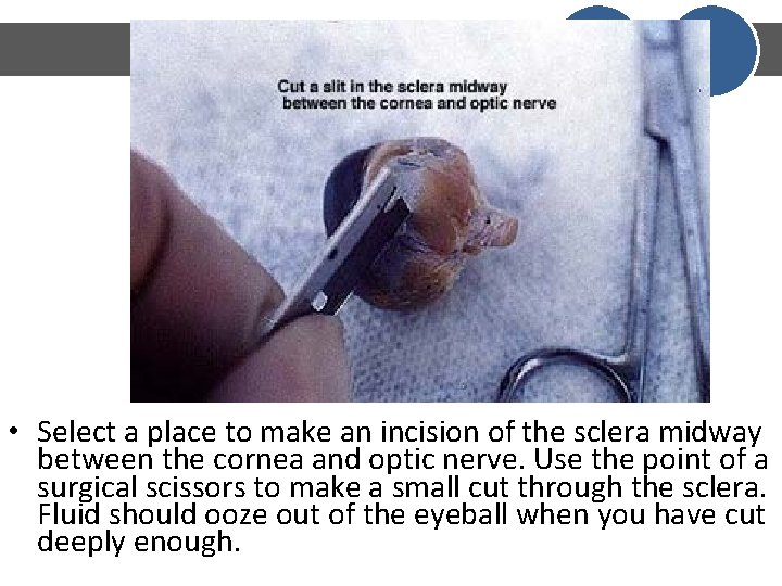 • Select a place to make an incision of the sclera midway between • Select a place to make an incision of the sclera midway between