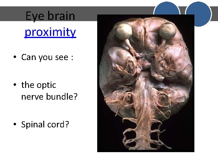 Eye brain proximity • Can you see : • the optic nerve bundle? • Eye brain proximity • Can you see : • the optic nerve bundle? •