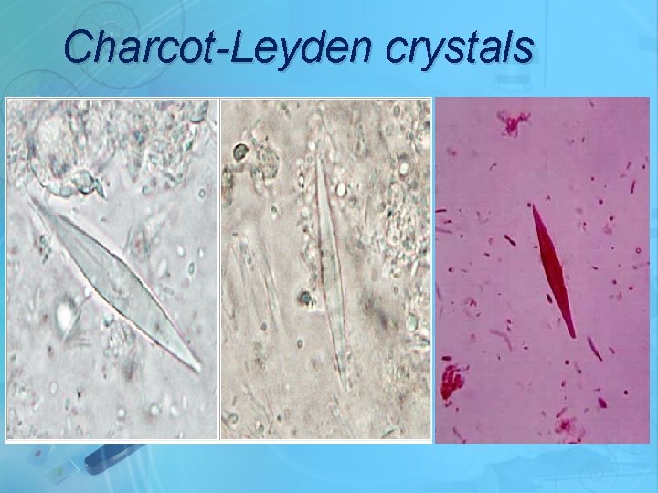 Charcot-Leyden crystals 
