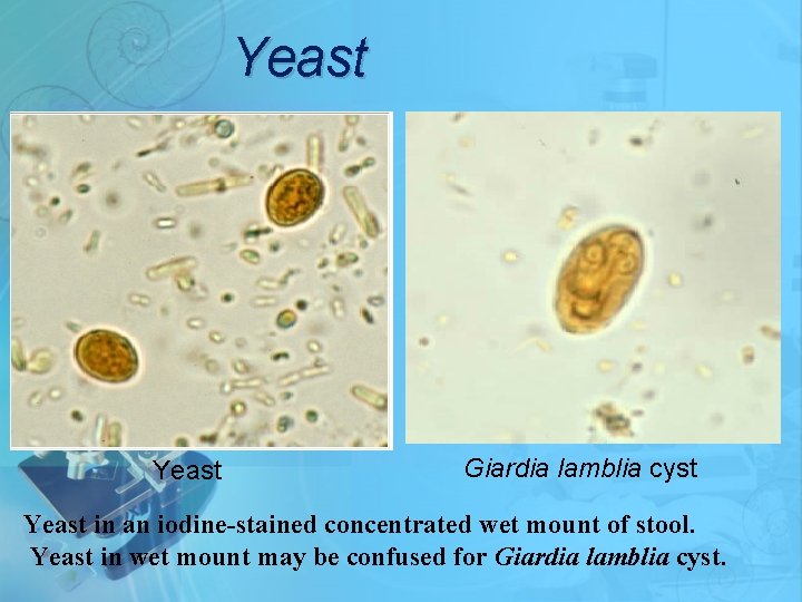 Yeast Giardia lamblia cyst Yeast in an iodine-stained concentrated wet mount of stool. Yeast